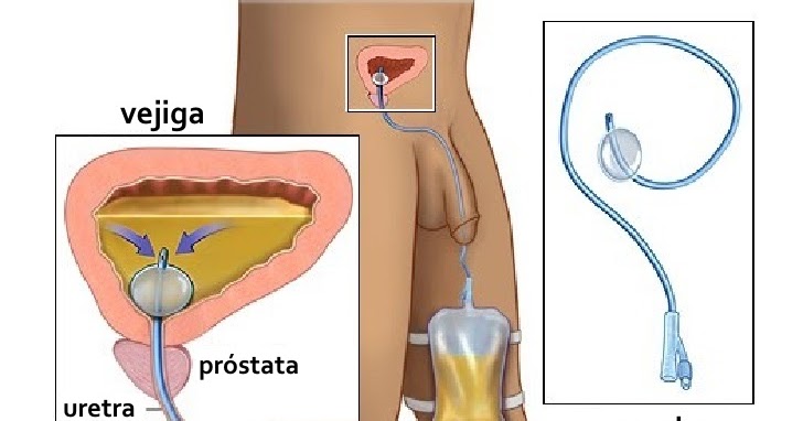 Gráfica con la introducción de una sonda vesical en una vejiga masculina.